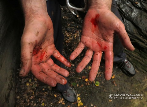 Kyle's bloody hands from not wearing rappelling gloves and not setting enough friction on his rappelling device.